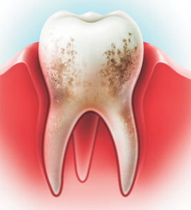 Схема кариеса на зубе
