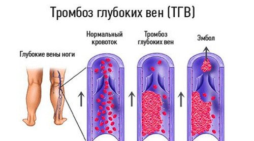 схема нормального кровотока и тромбоза глубоких вен