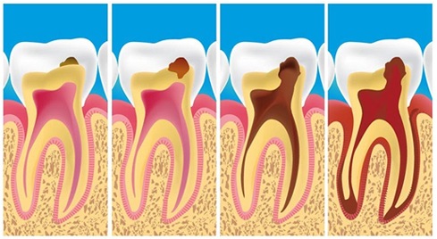 Схема разрушения зуба из-за кариеса