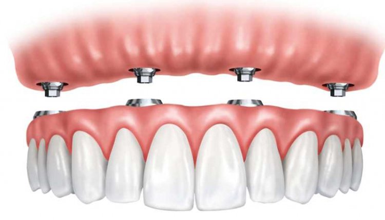 схема имплантации зубов на 4