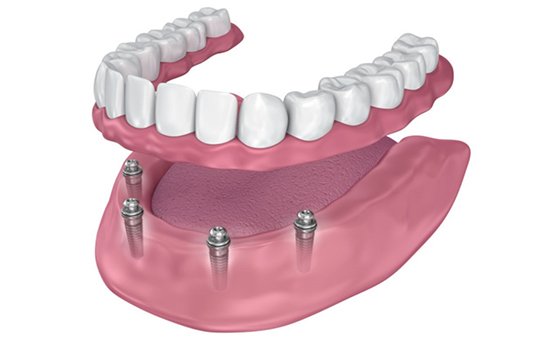 схема имплантации all-on-4 на нижний ряд зубов