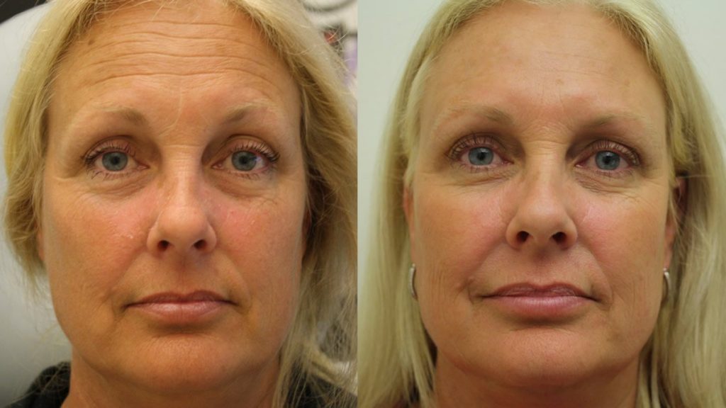 Фото до и после процедуры мезотерапии лица