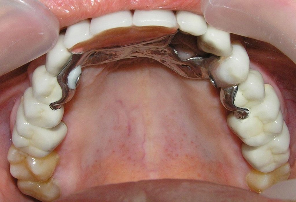 фото съёмного бюгельного протеза зубов на верхней челюсть