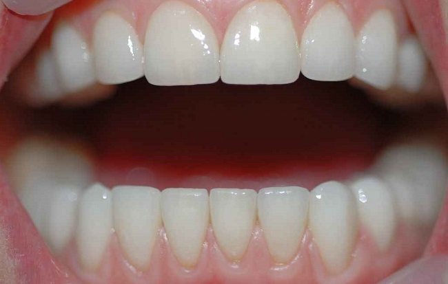 виниры Е-МАКС на зубах передней и жевательной группы