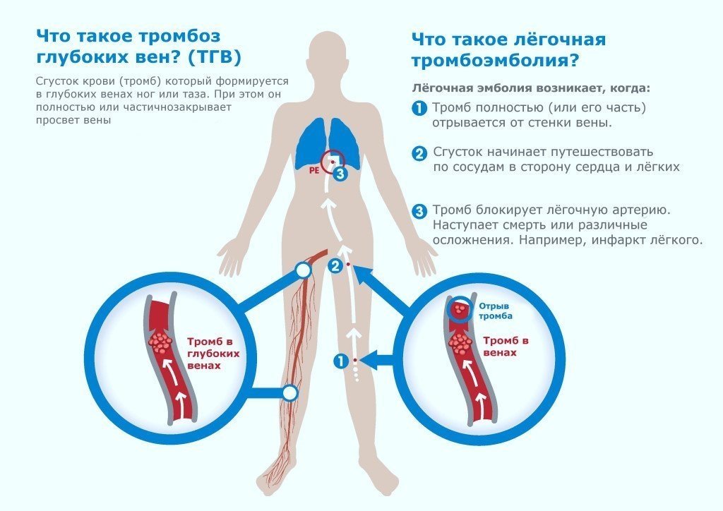 схема тромбоза глубогих вен и лёгочной эмболии