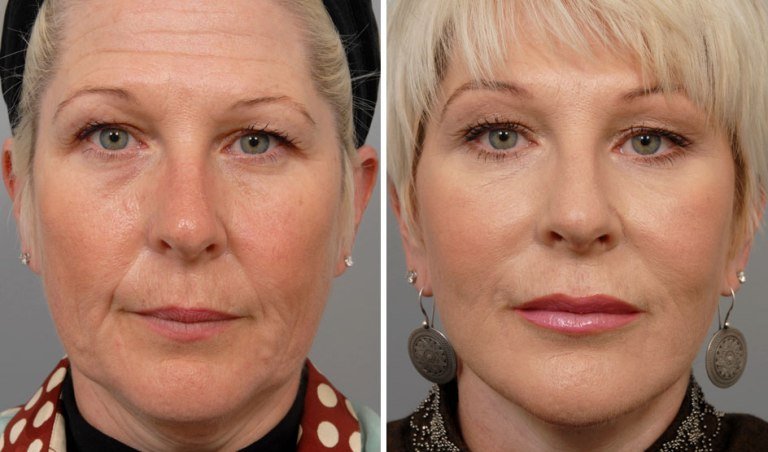 Фото до и после процедуры мезотерапии лица
